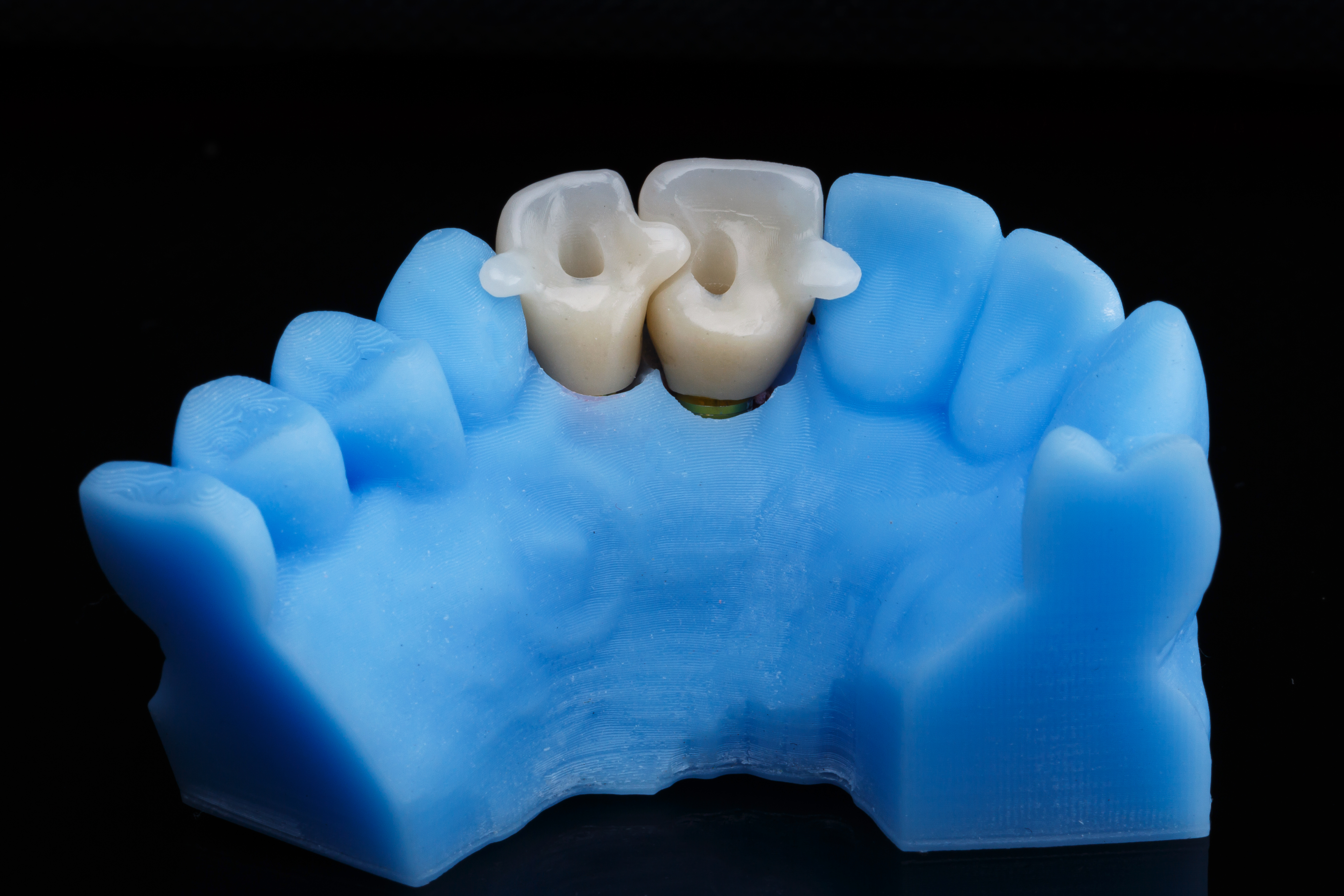 blue model printed on a 3D printer and special crowns with holders for patient installation